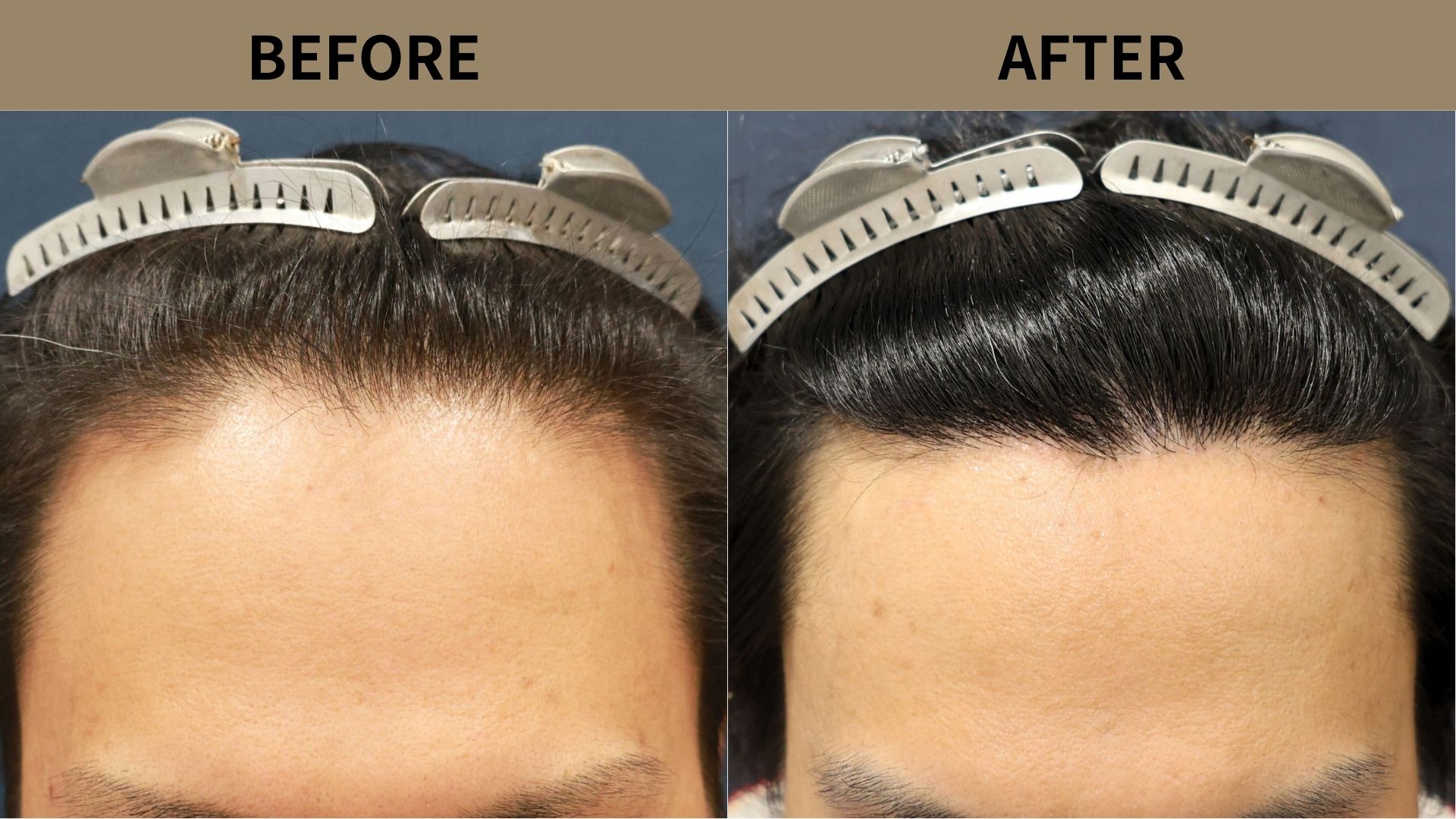 【自毛植毛 症例更新】40代男性｜生え際の薄毛・密度アップ1400グラフト