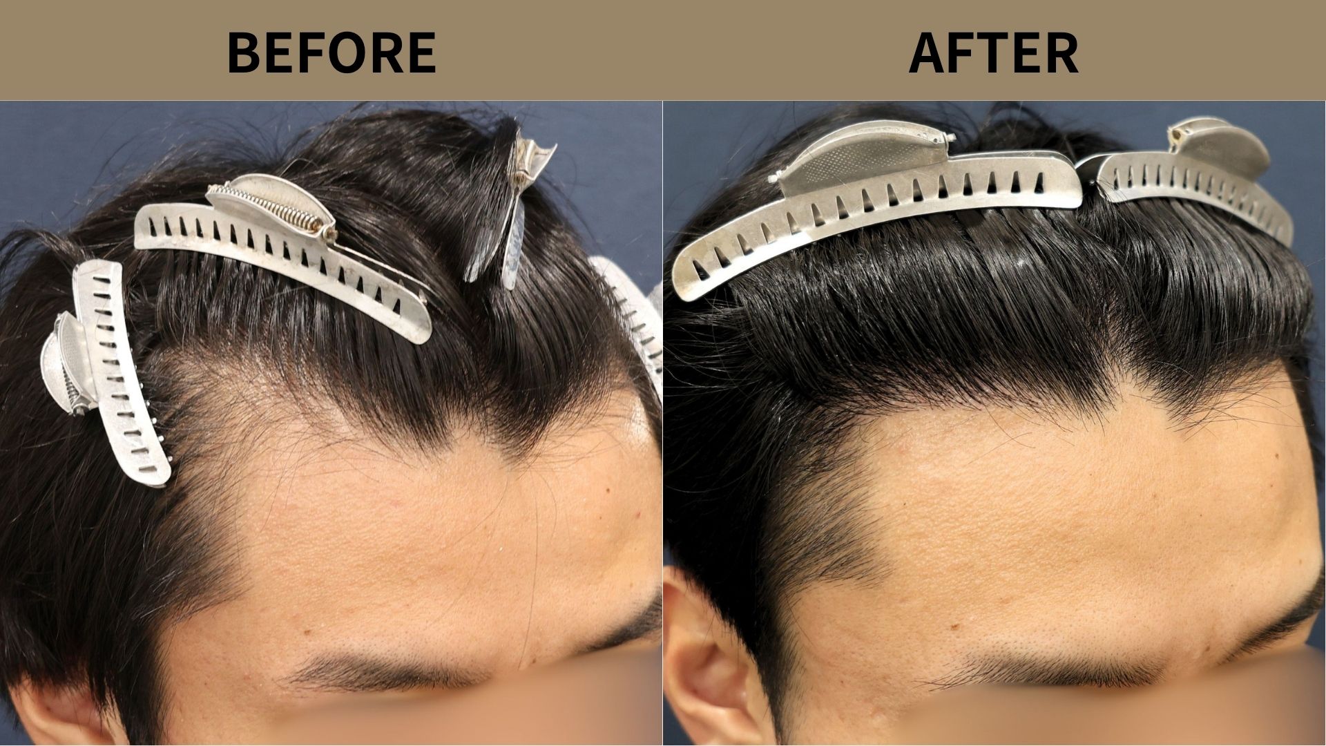 【自毛植毛 症例更新】20代男性｜生え際の薄毛1200グラフト