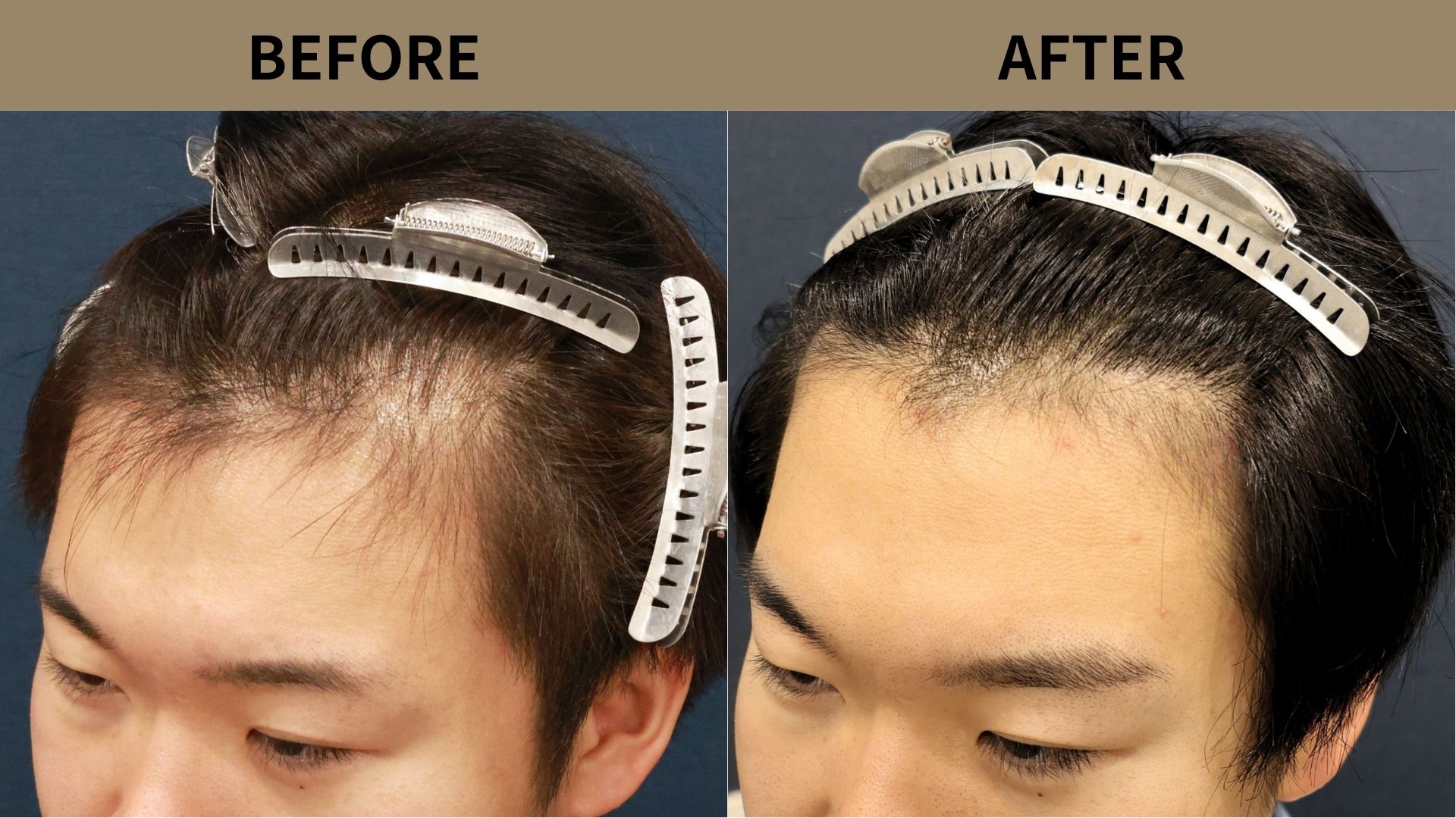 【自毛植毛 症例更新】20代男性｜生え際・M字の薄毛1000グラフト