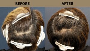 【自毛植毛 症例更新】30代男性｜頭頂部の薄毛1200グラフト