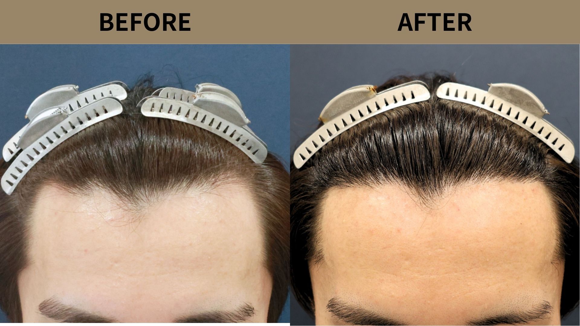 【植毛 症例更新】20代男性｜生え際の薄毛・密度アップ1000グラフト