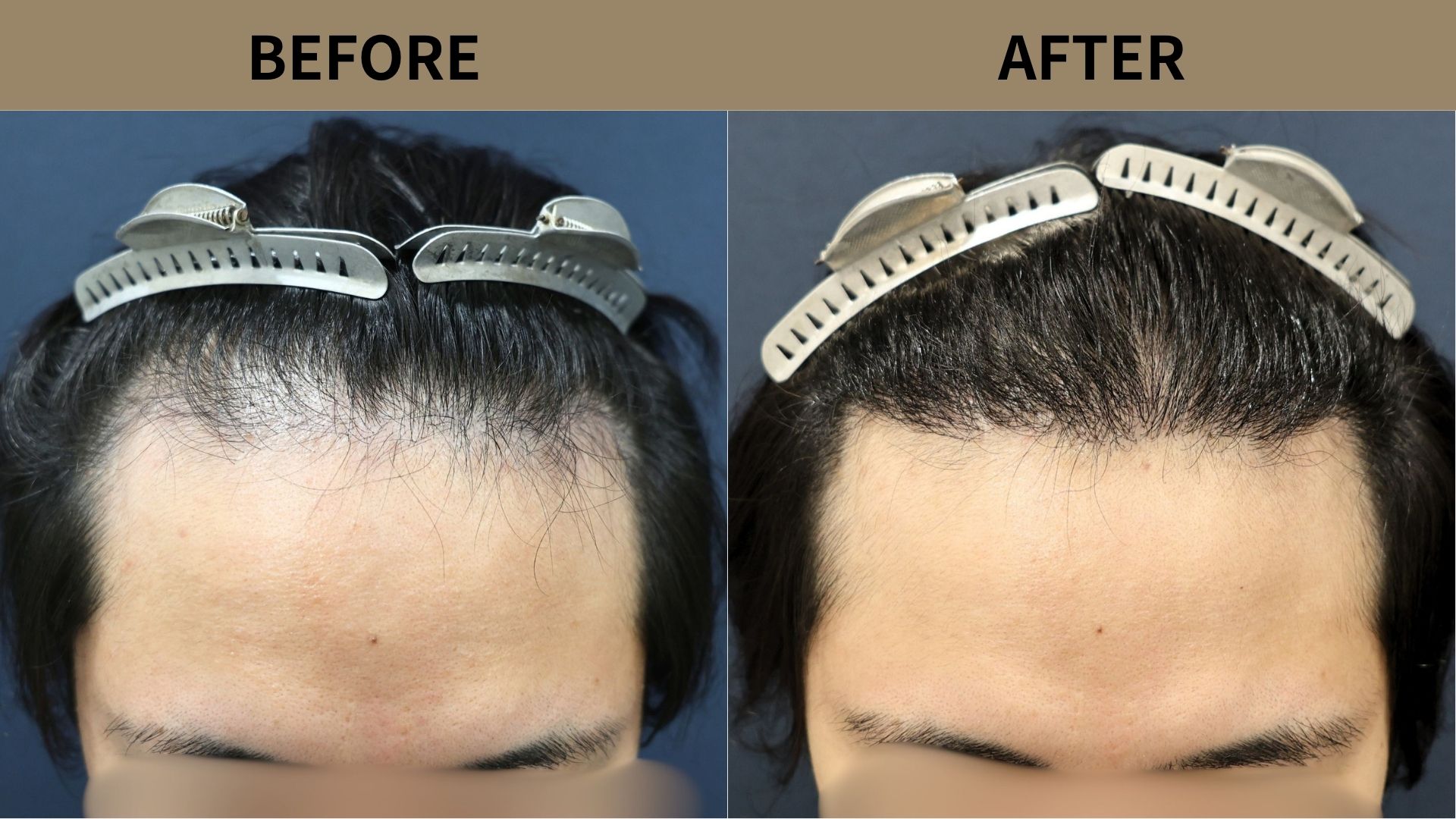 【自毛植毛 症例更新】20代男性｜生え際の薄毛1500グラフト