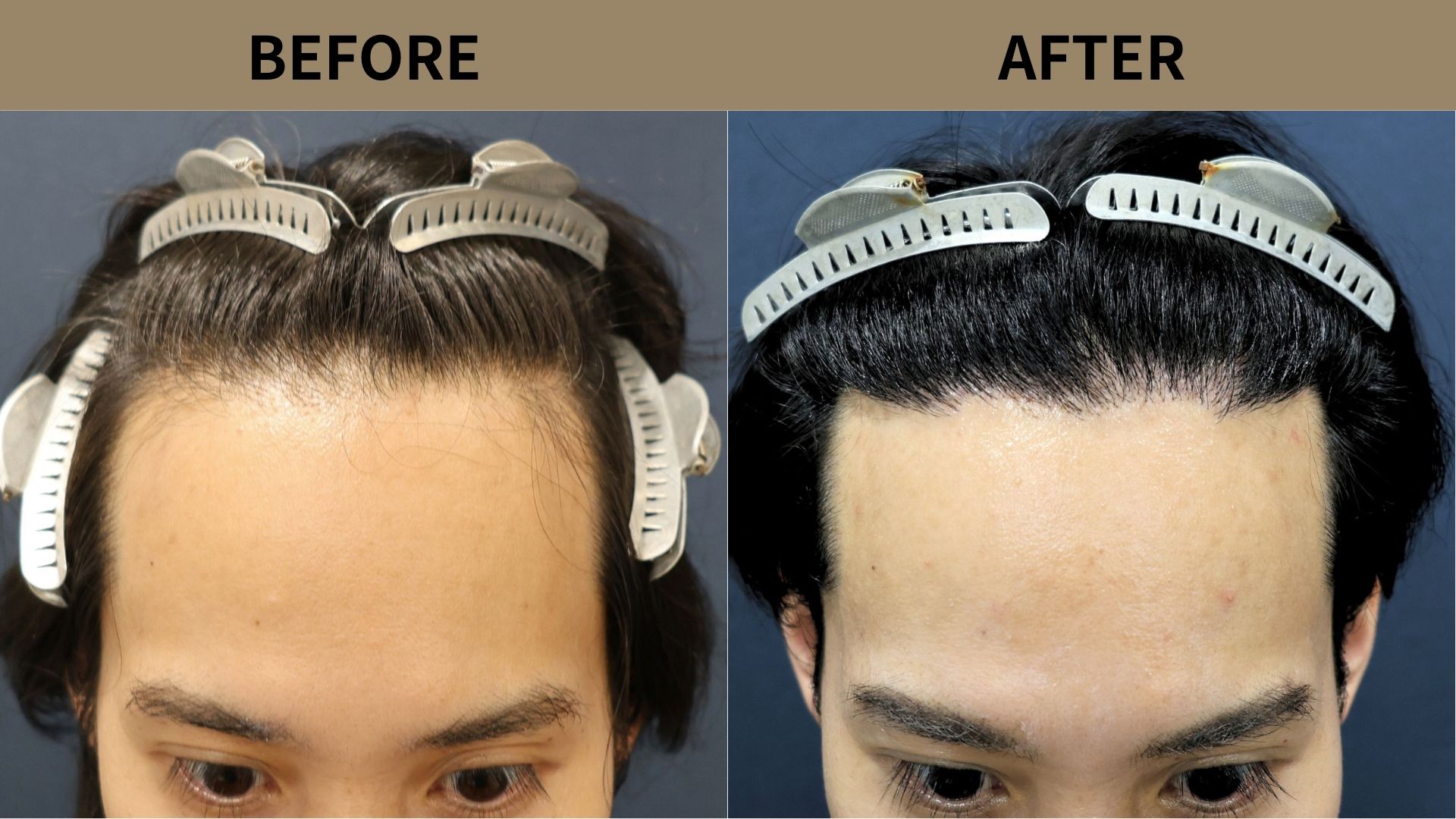 【植毛 症例更新】30代男性｜生え際の薄毛1500グラフト