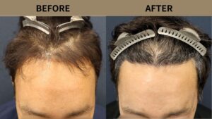 【植毛 症例更新】60代男性｜前額リフト傷跡修正・生え際密度アップ1600グラフト