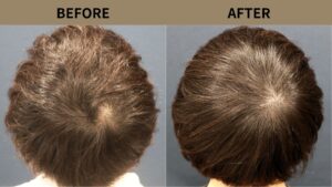 【植毛 症例更新】20代男性｜頭頂部の薄毛700グラフト