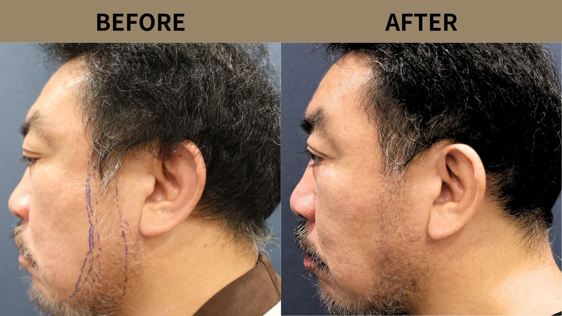 【自毛植毛 症例更新】50代男性｜ヒゲ植毛・他院修正800グラフト