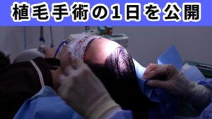 【必見】診察から始まる植毛手術の1日を完全公開します！