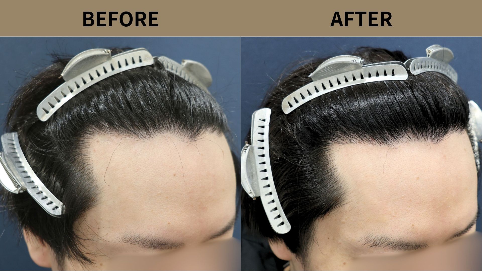 【植毛 症例更新】30代男性｜生え際の薄毛1200グラフト