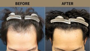 【自毛植毛 症例更新】30代男性｜生え際・M字の薄毛1100グラフト