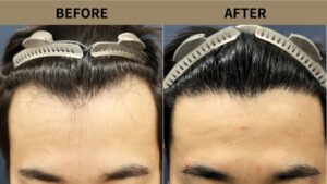 【自毛植毛 症例更新】30代男性｜生え際の薄毛1850グラフト