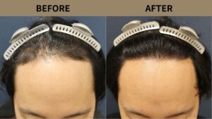 【自毛植毛 症例更新】30代男性｜生え際・前頭部の薄毛・当院2回目1200グラフト
