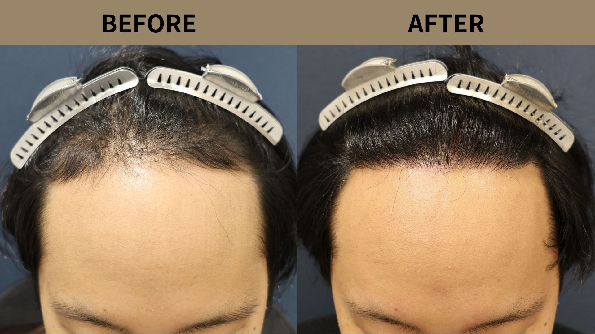 【自毛植毛 症例更新】30代男性｜生え際・前頭部の薄毛・当院2回目1200グラフト