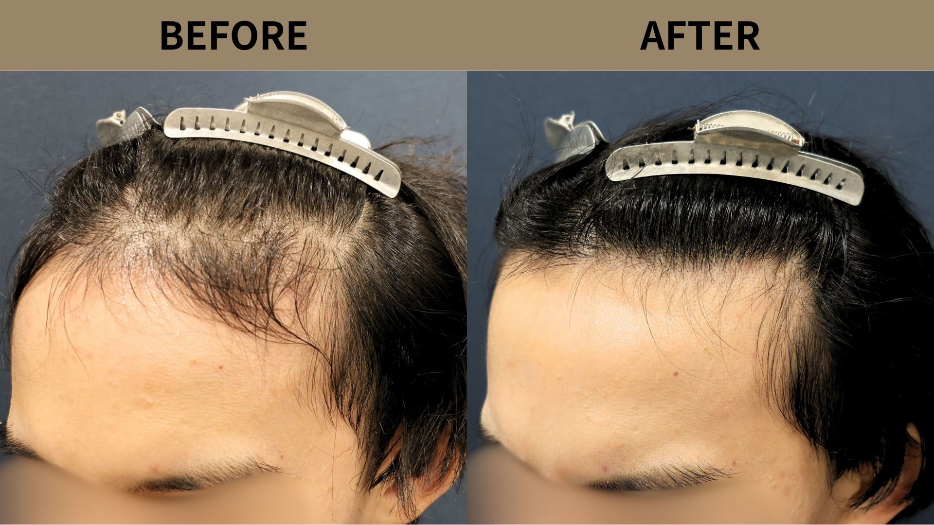 【植毛 症例更新】20代男性｜生え際1500グラフト 　