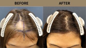 【植毛 症例更新】50代女性｜前頭部・瘢痕1500グラフト