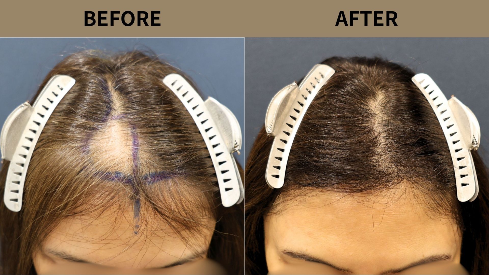 【植毛 症例更新】50代女性｜前頭部・瘢痕1500グラフト