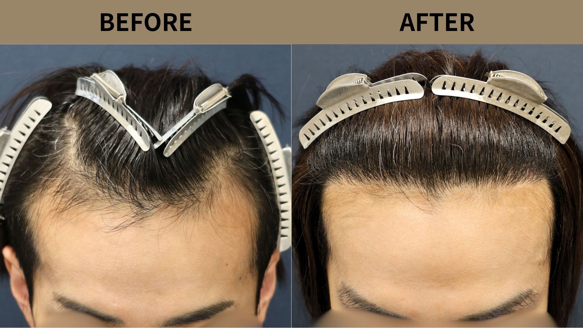 【植毛 症例更新】30代 男性｜生え際1700グラフト