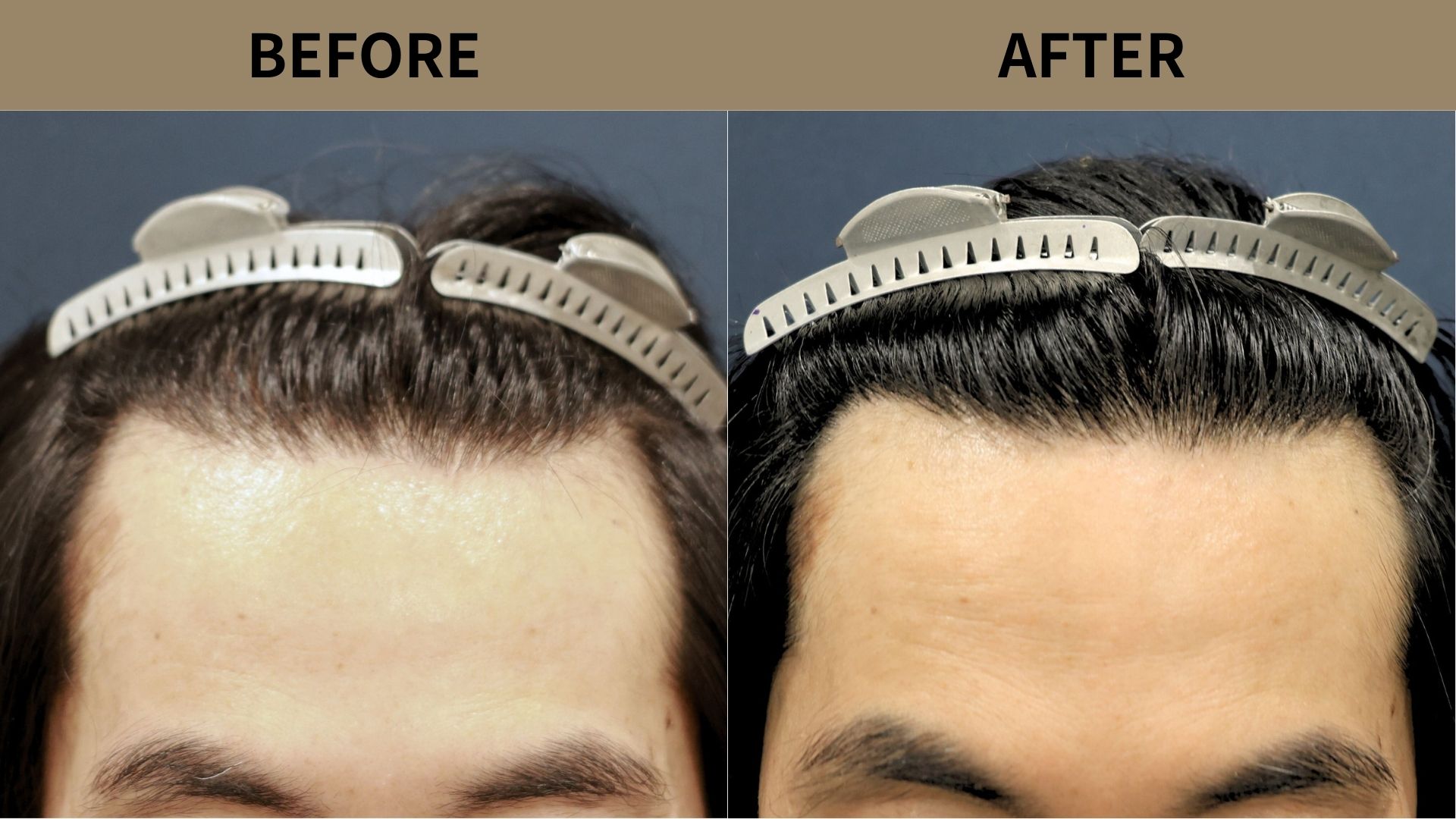 【植毛 症例更新】50代男性｜生え際・前頭部の薄毛・他院修正1400グラフト