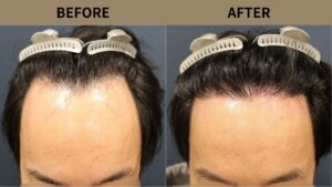 【植毛 症例更新】40代男性｜生え際の薄毛1600グラフト