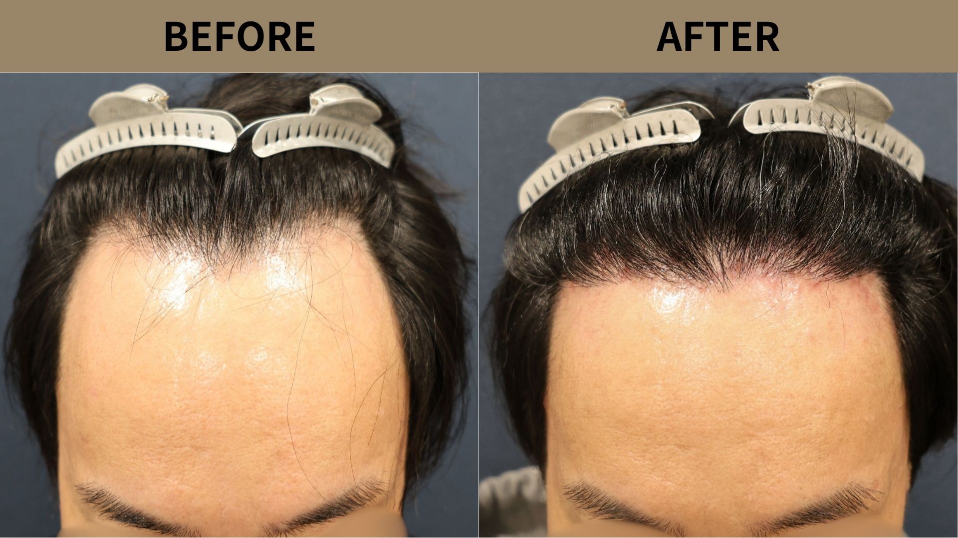 【植毛 症例更新】40代男性｜生え際の薄毛1600グラフト