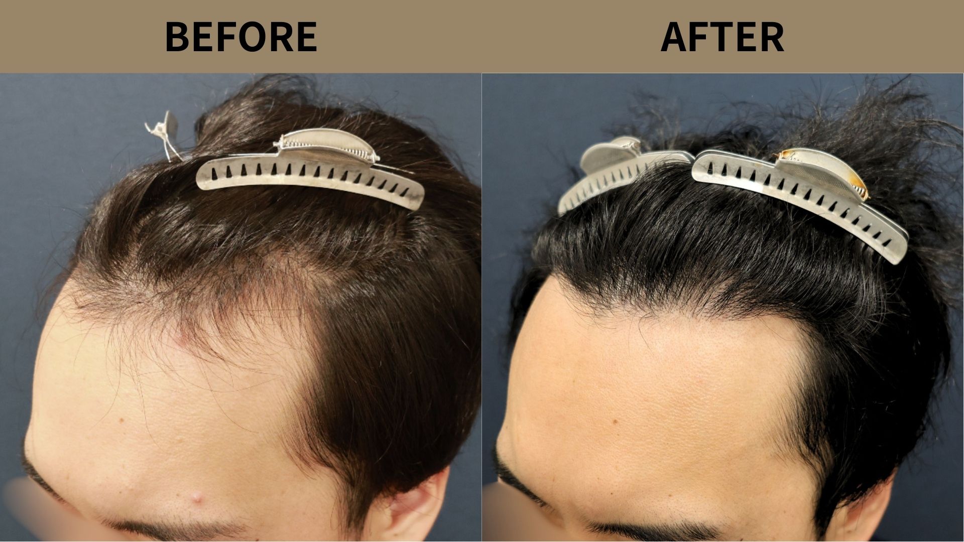 【植毛 症例更新】30代男性｜生え際の薄毛1500グラフト