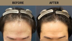 【植毛 症例更新】30代男性｜生え際・前頭部の薄毛1200グラフト