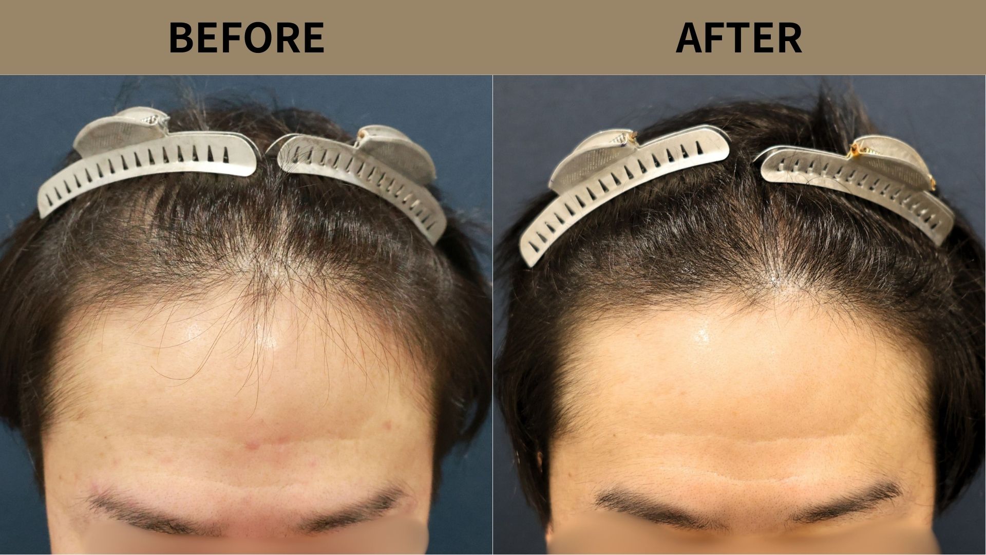 【植毛 症例更新】30代男性｜生え際・前頭部の薄毛1200グラフト