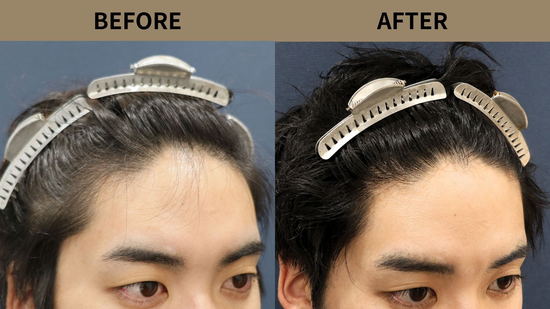 【植毛 症例更新】20代男性｜生え際850グラフト