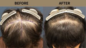 【植毛 症例更新】50代男性｜生え際・前頭部・他院修正2200グラフト