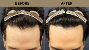 【植毛 症例更新】30代男性｜生え際・密度アップ・他院修正1800グラフト