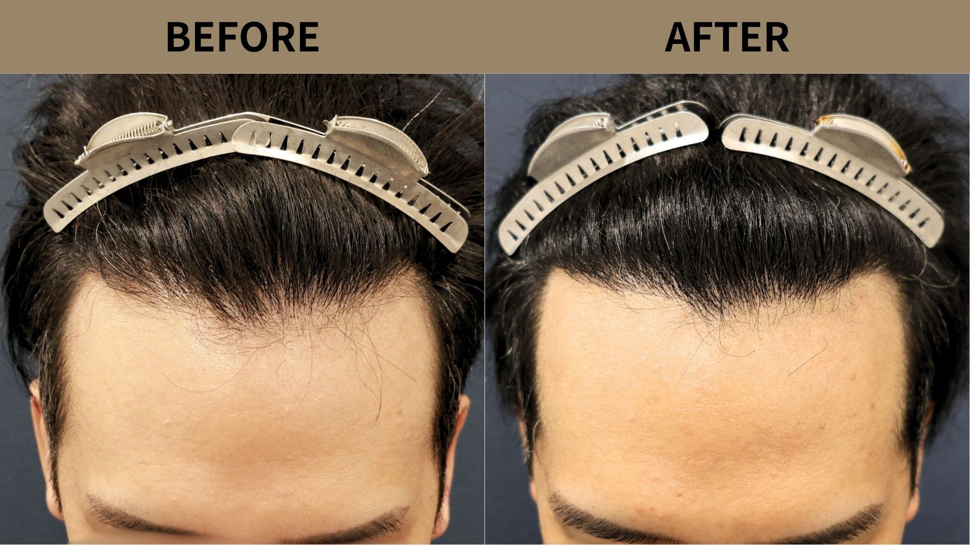 【植毛 症例更新】30代男性｜生え際・密度アップ・他院修正1800グラフト