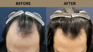 【植毛 症例更新】40代男性｜生え際1200グラフト