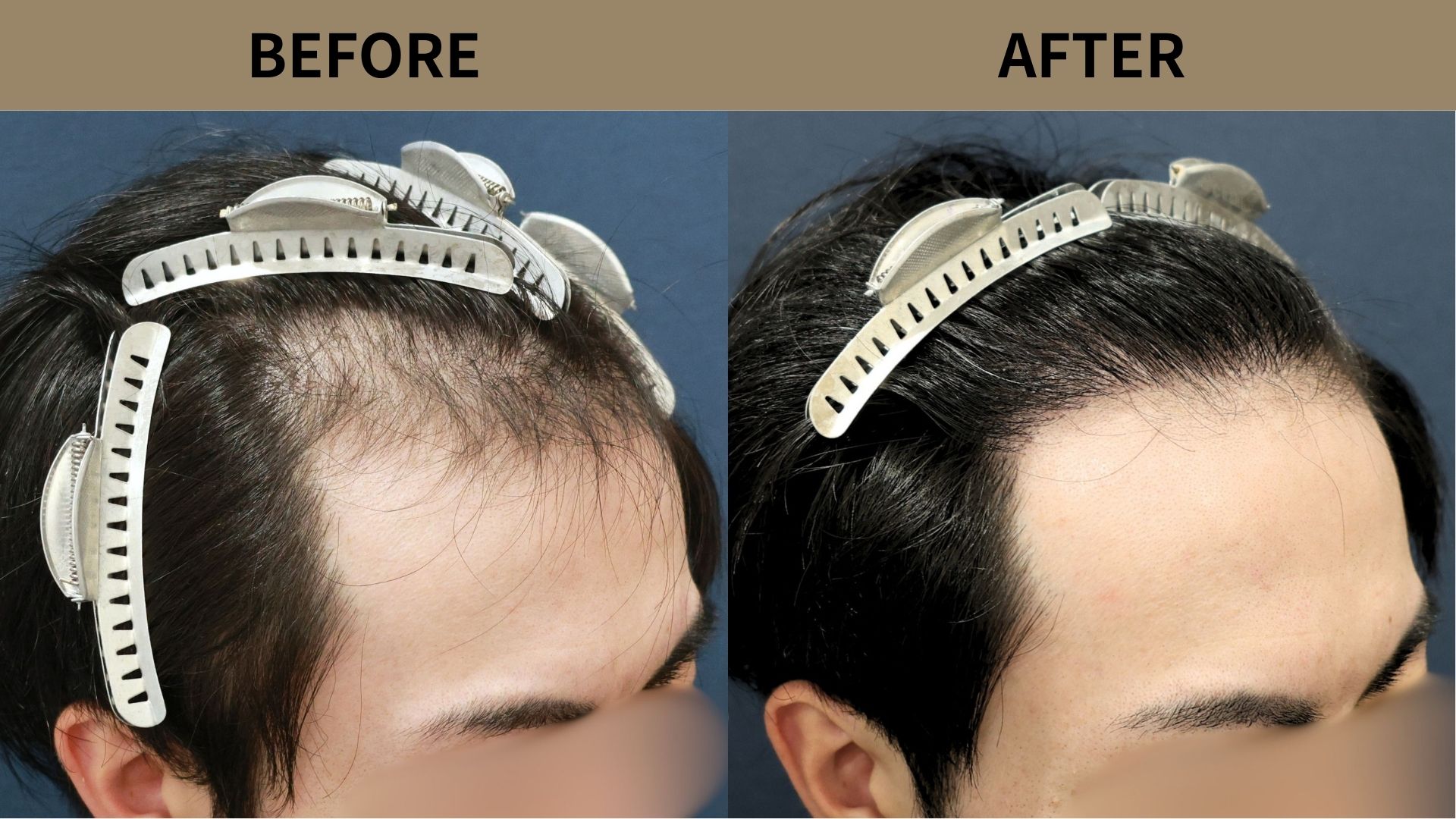 【植毛 症例更新】20代男性｜生え際1600グラフト