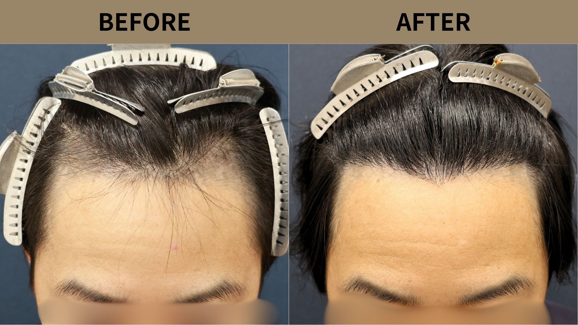 【植毛 症例更新】30代男性｜生え際1400グラフト