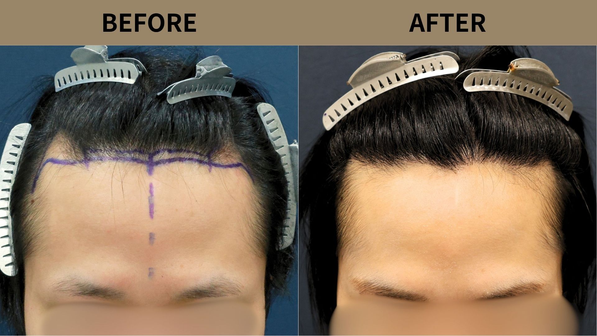 【植毛 症例更新】20代男性｜生え際・M字1300グラフト