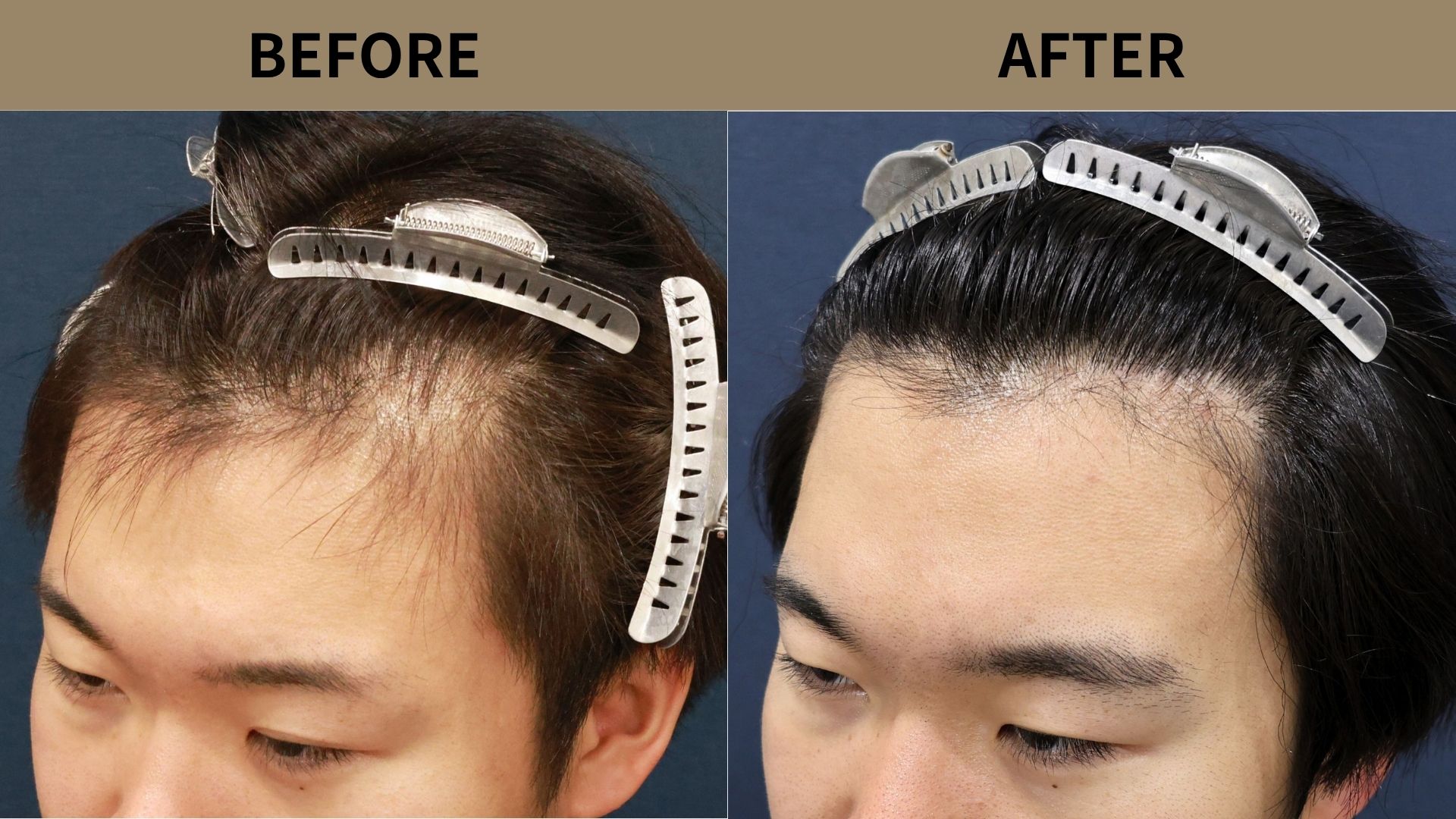 【植毛 症例更新】20代男性｜生え際 1000グラフト