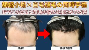 額縮小術×自毛植毛の同時手術｜おでこの広さと薄毛の悩みを根本から改善